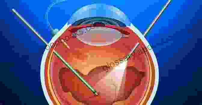 Advanced Surgical Techniques For Vitreoretinal Diseases Management Of Complicated Vitreoretinal Diseases