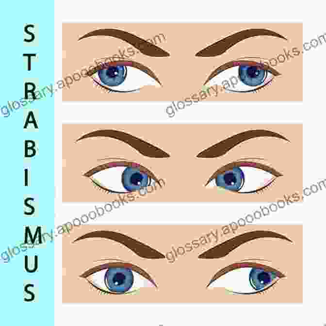 Anatomy Of Strabismus Strabismus Simplified Second Edition Mosby