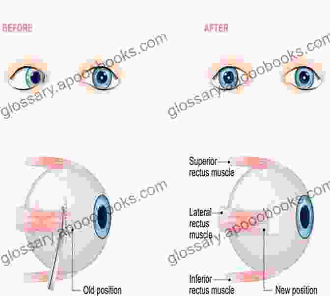 Strabismus Surgical Procedures Strabismus Simplified Second Edition Mosby