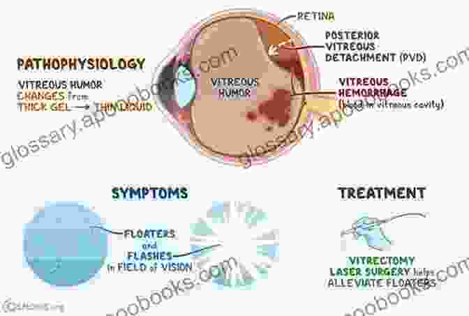 Surgical Management Of Vitreoretinal Diseases Management Of Complicated Vitreoretinal Diseases