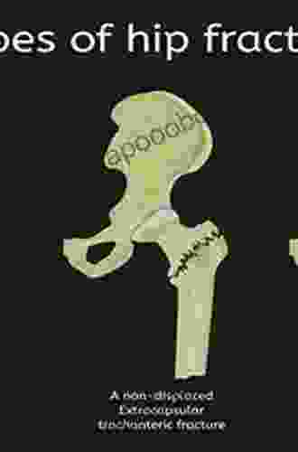 Fractures of the Hip (Fracture Management Joint by Joint)